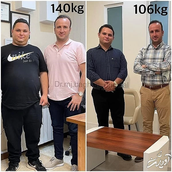 جراحی اسلیو معده